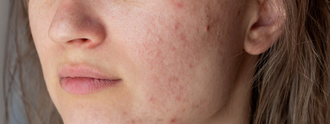 Acne and Menopause: Understanding the Link & Finding Relief